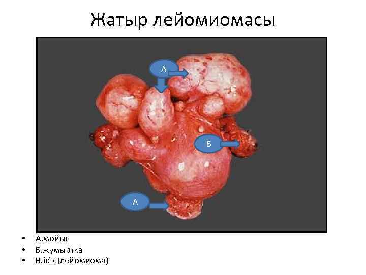 Жатыр лейомиомасы А Б А • • • А. мойын Б. жұмыртқа В. ісік