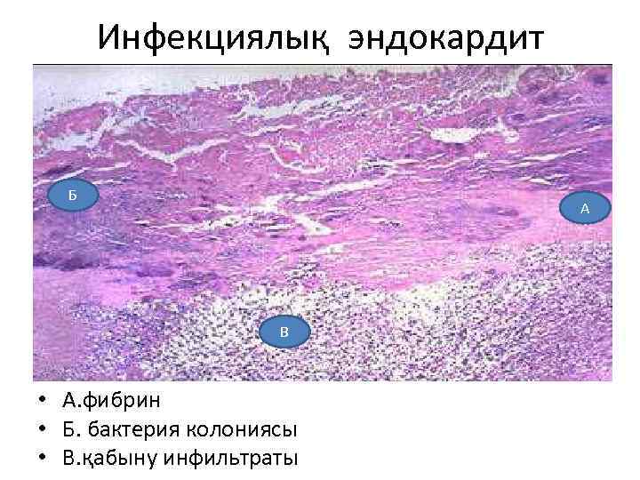 Инфекциялық эндокардит Б А В • А. фибрин • Б. бактерия колониясы • В.