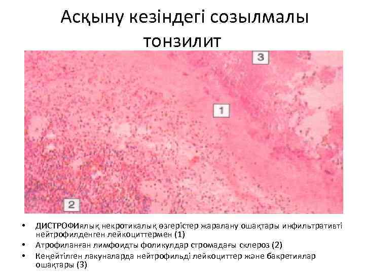 Асқыну кезіндегі созылмалы тонзилит • • • ДИСТРОФИялық некротикалық өзгерістер жаралану ошақтары инфильтративті нейтрофилденген