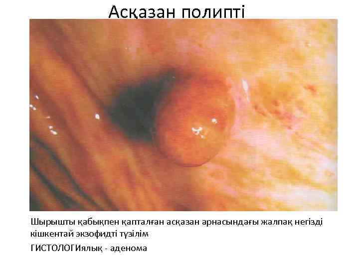 Асқазан полипті Шырышты қабықпен қапталған асқазан арнасындағы жалпақ негізді кішкентай экзофидті түзілім ГИСТОЛОГИялық -