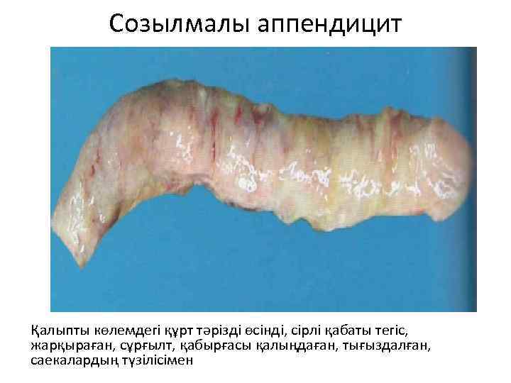 Созылмалы аппендицит Қалыпты көлемдегі құрт тәрізді өсінді, сірлі қабаты тегіс, жарқыраған, сұрғылт, қабырғасы қалыңдаған,