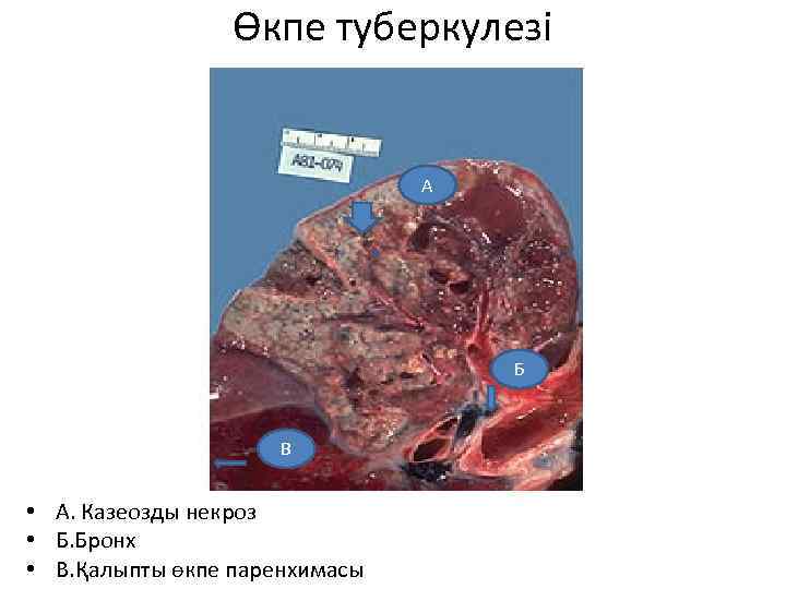 Өкпе туберкулезі А Б В • А. Казеозды некроз • Б. Бронх • В.