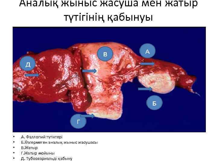 Аналық жыныс жасуша мен жатыр түтігінің қабынуы • • • А. Фаллопий түтіктері Б.