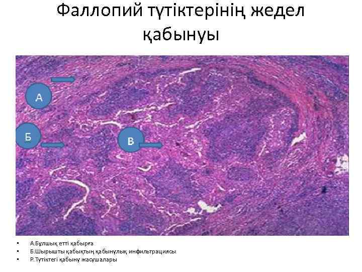 Фаллопий түтіктерінің жедел қабынуы • • • А. Бұлшық етті қабырға Б. Шырышты қабықтың