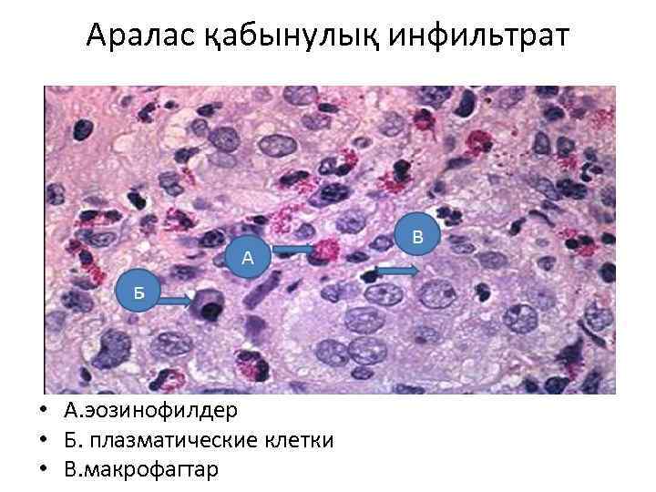 Аралас қабынулық инфильтрат • А. эозинофилдер • Б. плазматические клетки • В. макрофагтар 