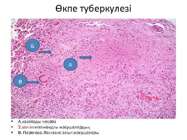 Өкпе туберкулезі • • • А. казеозды некроз 2. вал эпителиоидты жасушалардың В. Пирогова-Лангханс