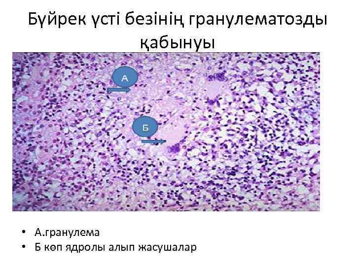 Бүйрек үсті безінің гранулематозды қабынуы • А. гранулема • Б көп ядролы алып жасушалар