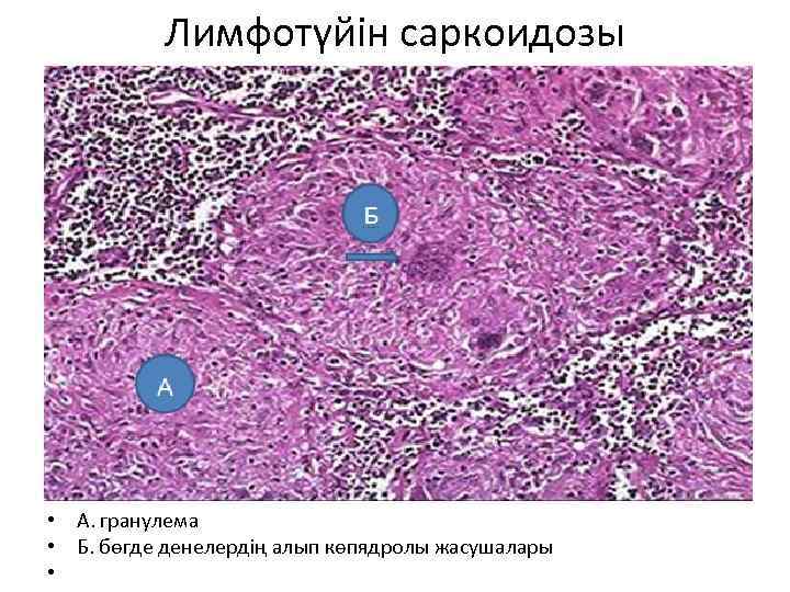 Лимфотүйін саркоидозы • А. гранулема • Б. бөгде денелердің алып көпядролы жасушалары • 