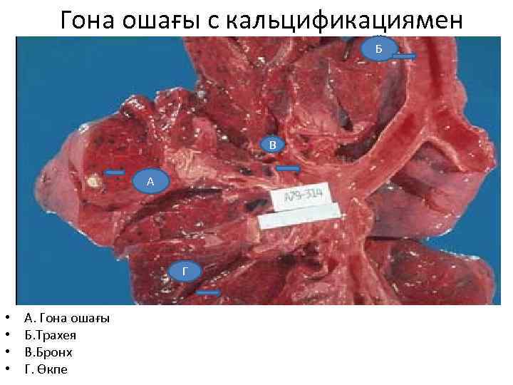  Гона ошағы с кальцификациямен Б В А Г • • А. Гона ошағы