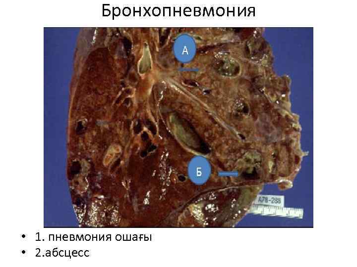 Бронхопневмония • 1. пневмония ошағы • 2. абсцесс 