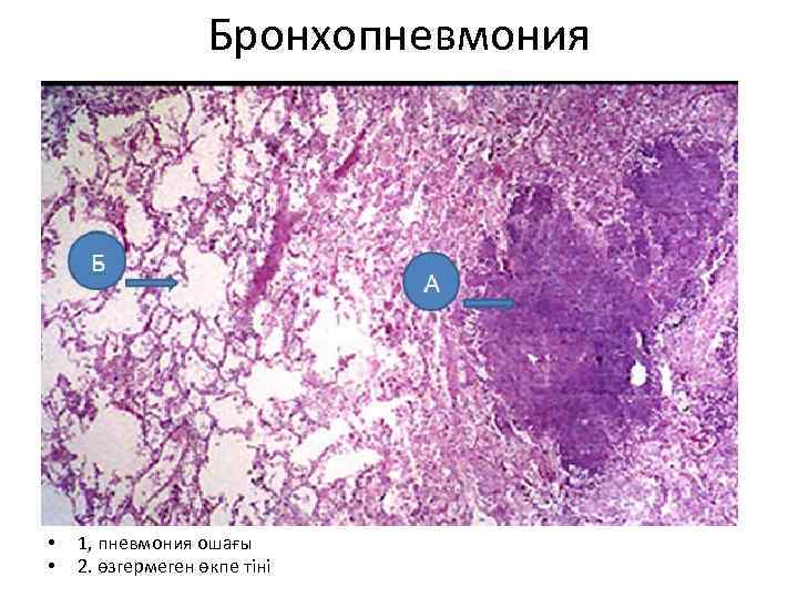 Бронхопневмония • • 1, пневмония ошағы 2. өзгермеген өкпе тіні 