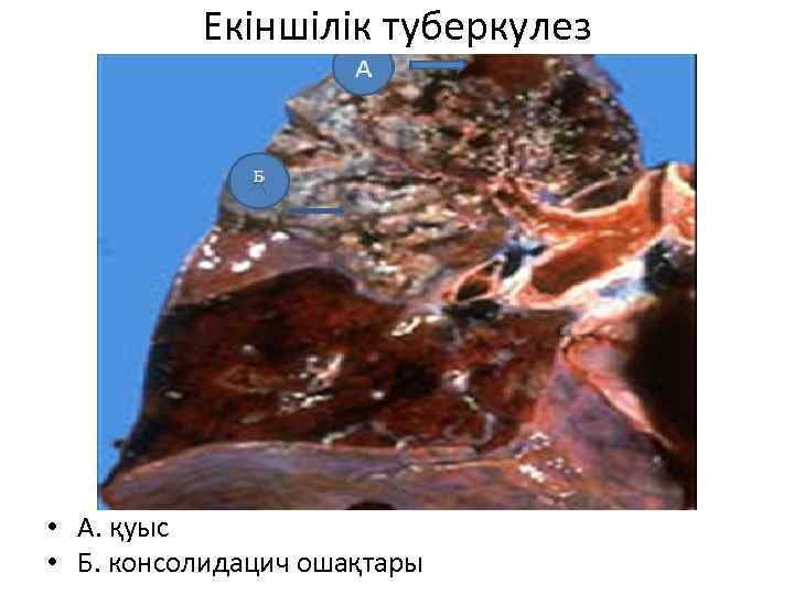 Екіншілік туберкулез • А. қуыс • Б. консолидацич ошақтары 