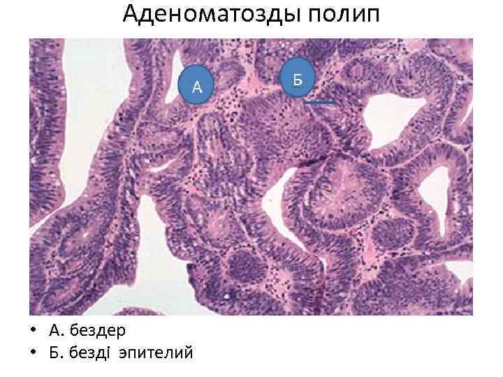 Аденоматозды полип Аденоматозный полип А. Железы Б. железистый эпителий • А. бездер • Б.