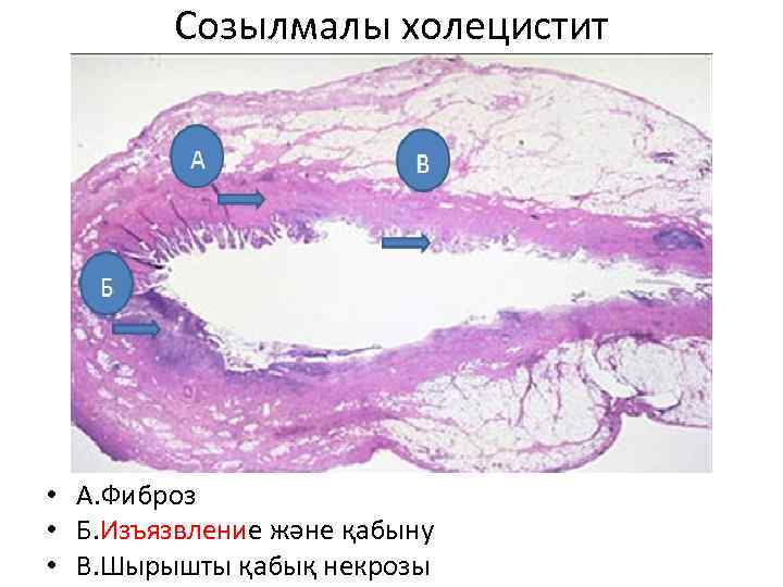 Созылмалы холецистит • А. Фиброз • Б. Изъязвление және қабыну • В. Шырышты қабық