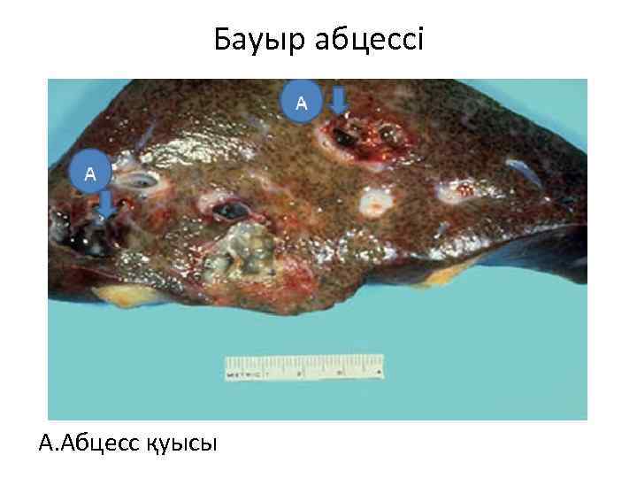 Бауыр абцессі А. Абцесс қуысы 