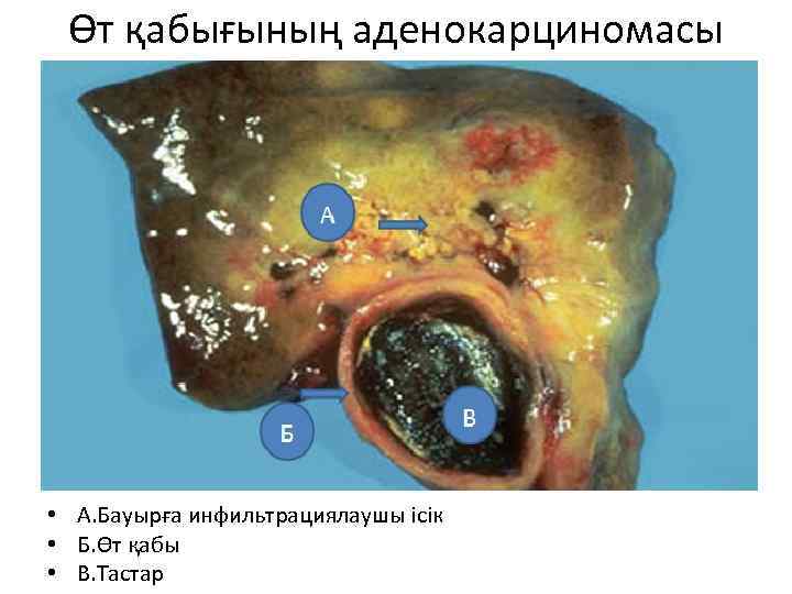 Өт қабығының аденокарциномасы • • А. Бауырға инфильтрациялаушы ісік Б. Өт қабы В. Тастар