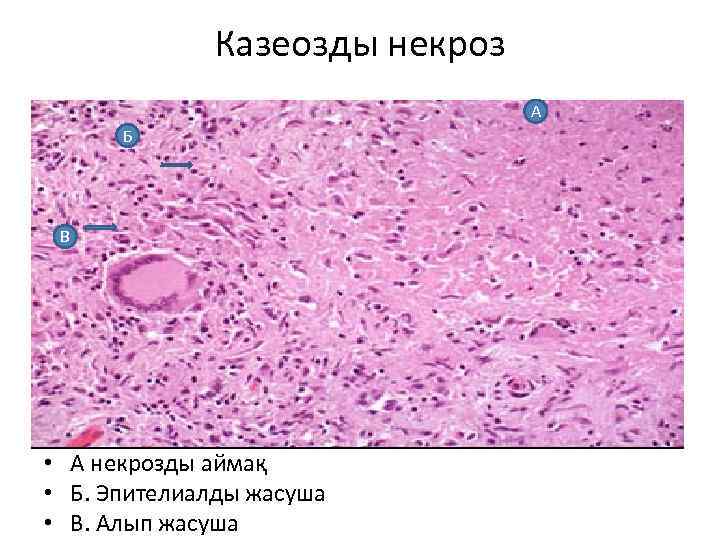 Казеозды некроз А Б В • А некрозды аймақ • Б. Эпителиалды жасуша •