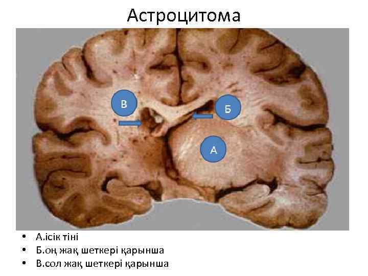 Астроцитома • А. ісік тіні • Б. оң жақ шеткері қарынша • В. сол