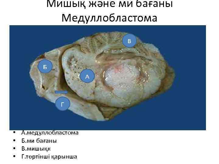 Мишық және ми бағаны Медуллобластома • • А. медуллобластома Б. ми бағаны В. мишықк