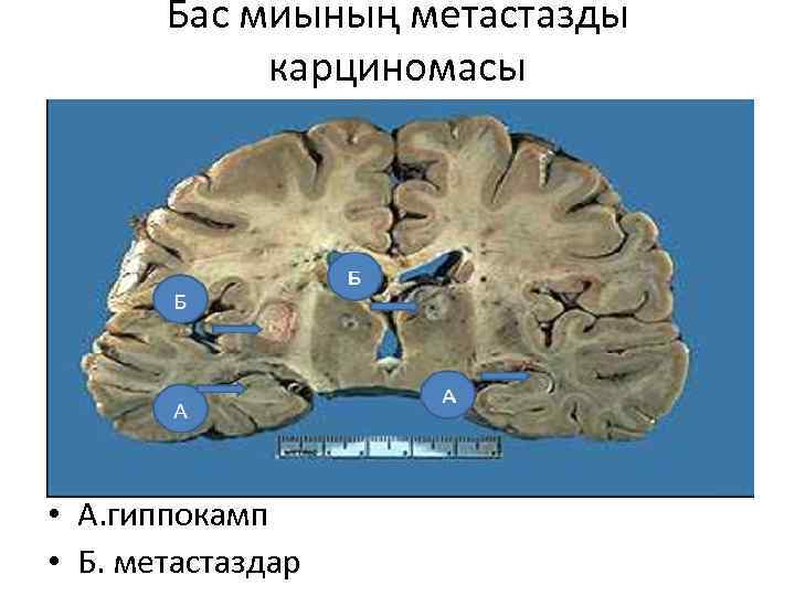 Бас миының метастазды карциномасы • А. гиппокамп • Б. метастаздар 