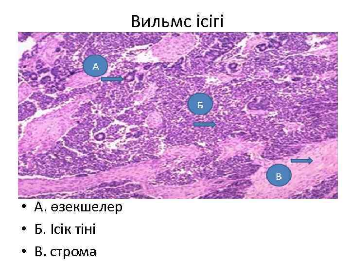 Вильмс ісігі • А. өзекшелер • Б. Ісік тіні • В. строма 