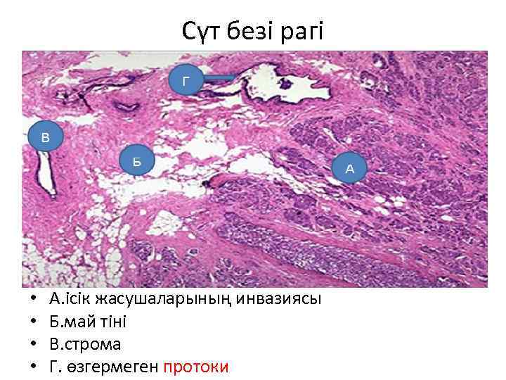 Сүт безі рагі • • А. ісік жасушаларының инвазиясы Б. май тіні В. строма