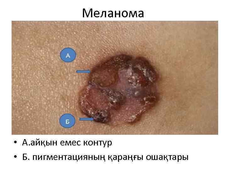 Меланома • А. айқын емес контур • Б. пигментацияның қараңғы ошақтары 