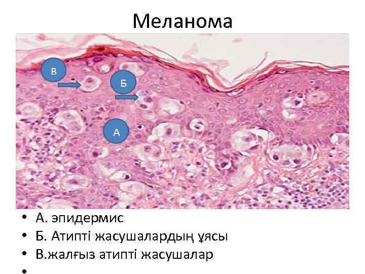Меланома • А. эпидермис • Б. Атипті жасушалардың ұясы • В. жалғыз атипті жасушалар