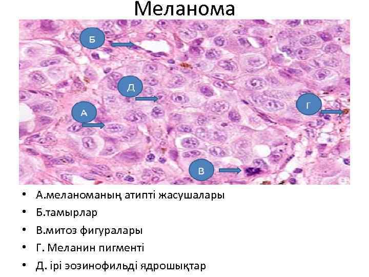 Меланома • • • А. меланоманың атипті жасушалары Б. тамырлар В. митоз фигуралары Г.