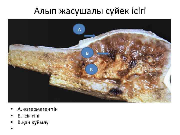 Алып жасушалы сүйек ісігі • • А. өзгермеген тін Б. ісік тіні В. қан
