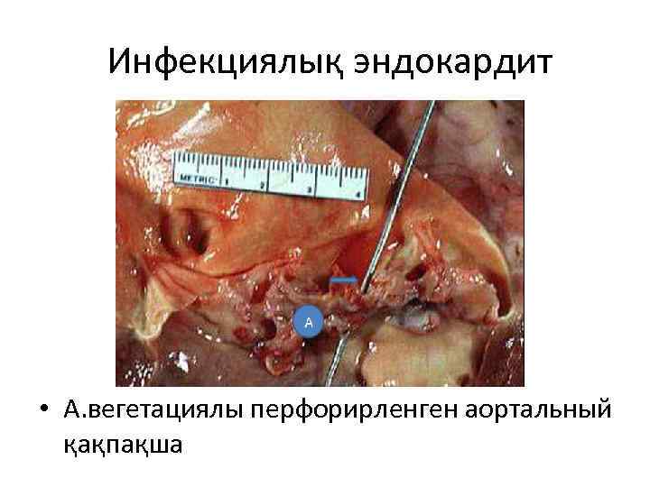  Инфекциялық эндокардит • А. вегетациялы перфорирленген аортальный қақпақша 