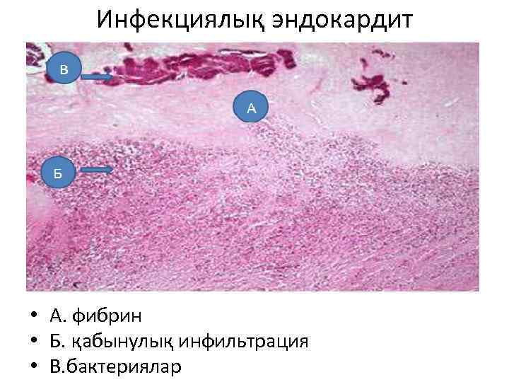 Инфекциялық эндокардит • А. фибрин • Б. қабынулық инфильтрация • В. бактериялар 