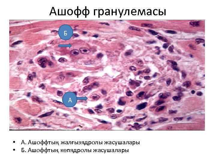 Ашофф гранулемасы • А. Ашоффтың жалғызядролы жасушалары • Б. Ашоффтың көпядролы жасушалары 