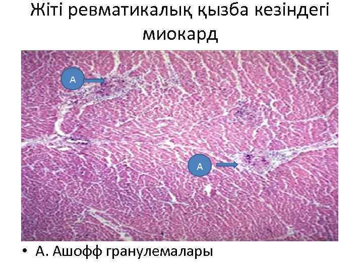 Жіті ревматикалық қызба кезіндегі миокард • А. Ашофф гранулемалары 