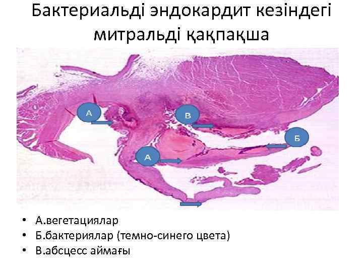 Бактериальді эндокардит кезіндегі митральді қақпақша • А. вегетациялар • Б. бактериялар (темно-синего цвета) •