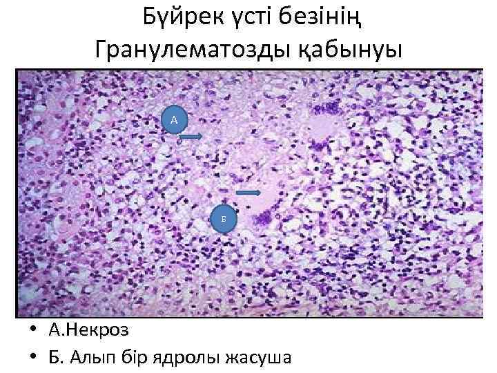  Бүйрек үсті безінің Гранулематозды қабынуы А Б • А. Некроз • Б. Алып