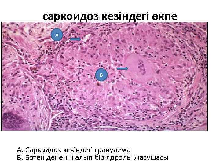саркоидоз кезіндегі өкпе А Б А. Саркаидоз кезіндегі гранулема Б. Бөтен дененің алып бір