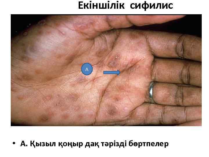 Екіншілік сифилис А • А. Қызыл қоңыр дақ тәрізді бөртпелер 