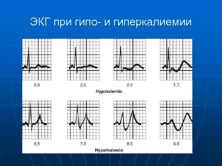 Экг при гиперкалиемии картинки