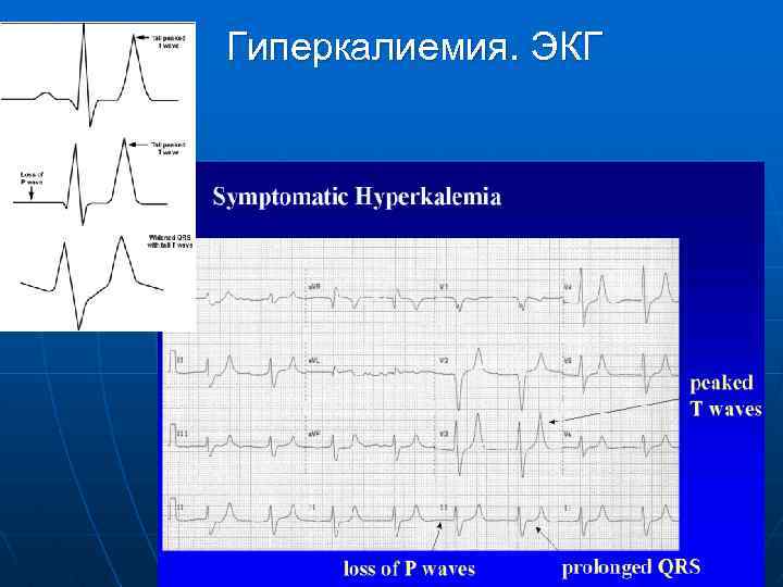 Экг при гиперкалиемии картинки