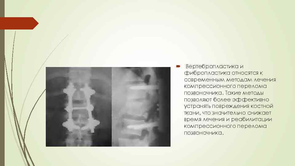  Вертебропластика и фибропластика относятся к современным методам лечения компрессионного перелома позвоночника. Такие методы