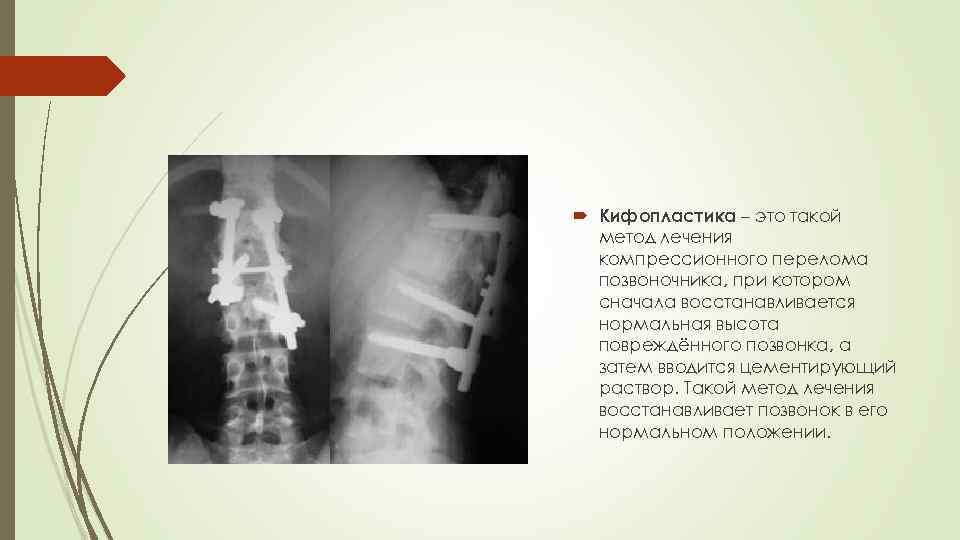  Кифопластика – это такой метод лечения компрессионного перелома позвоночника, при котором сначала восстанавливается