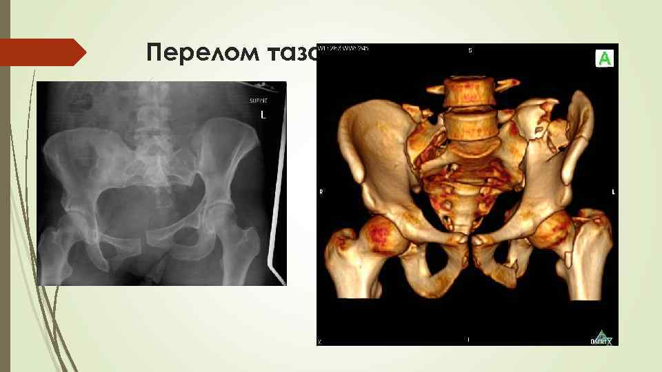 Перелом таза 