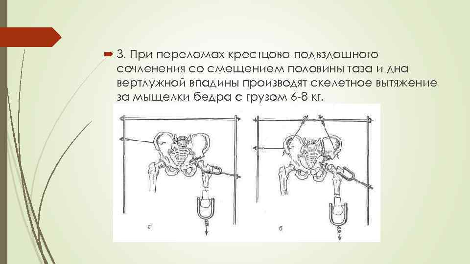  3. При переломах крестцово-подвздошного сочленения со смещением половины таза и дна вертлужной впадины