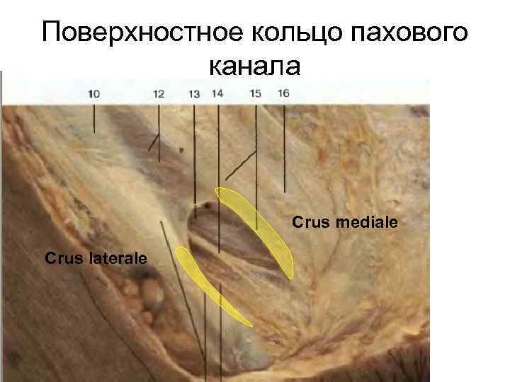 Поверхностное кольцо пахового канала Crus mediale Crus laterale 