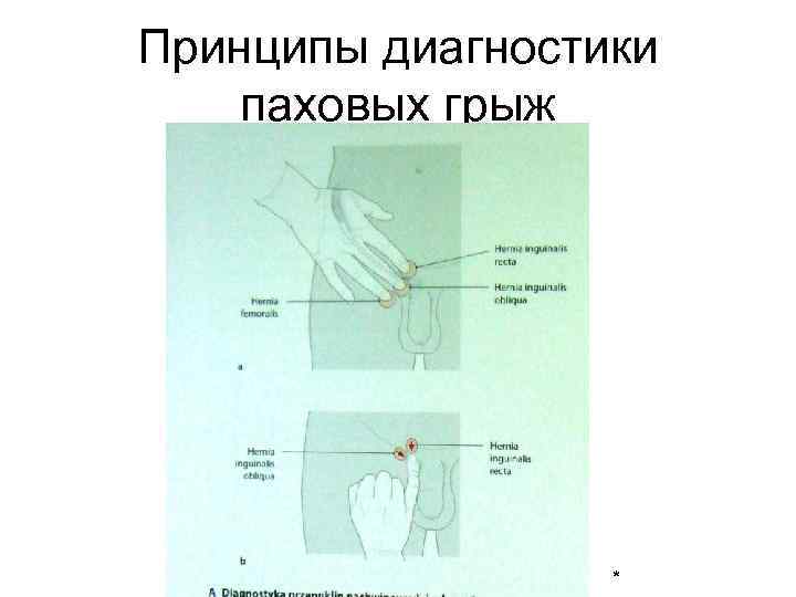 Принципы диагностики паховых грыж * 