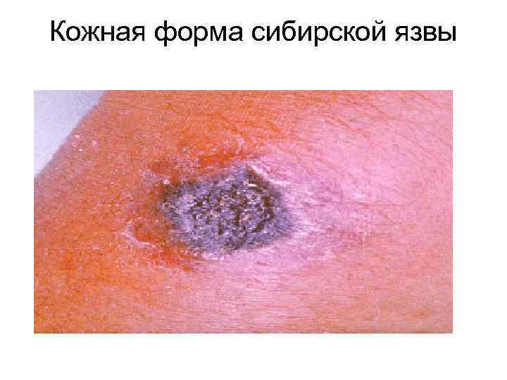 Кожная форма сибирской язвы 