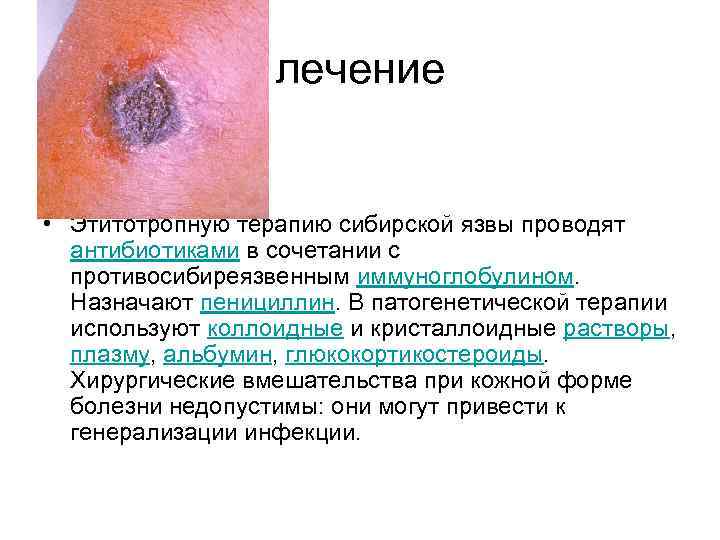 лечение • Этитотропную терапию сибирской язвы проводят антибиотиками в сочетании с противосибиреязвенным иммуноглобулином. Назначают