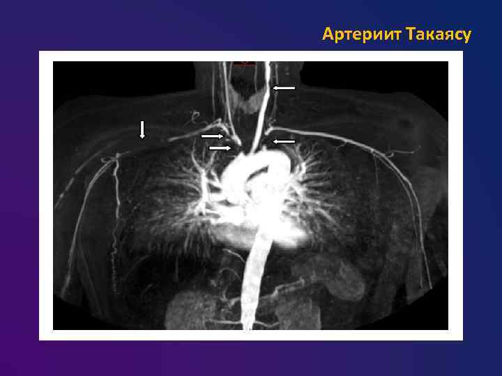 Артериит такаясу презентация