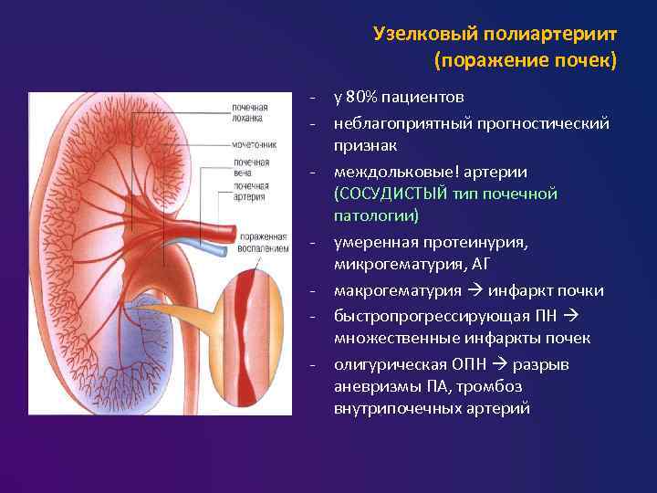 Узелковый полиартериит (поражение почек) - - у 80% пациентов неблагоприятный прогностический признак междольковые! артерии